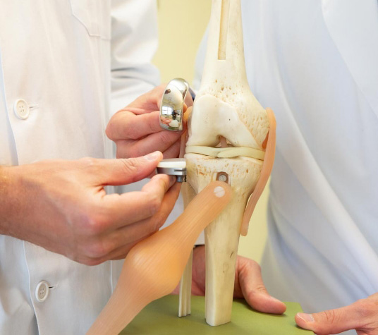 Modello anatomico del ginocchio con componente protesica